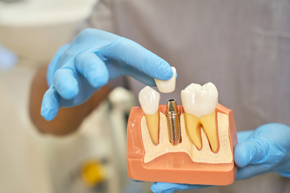 https://dent-estet.com/wp-content/uploads/2024/08/dentalna-implantologija.jpg